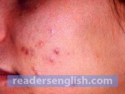 acne Urdu meaning