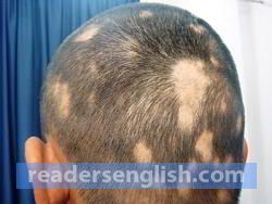 alopecia Urdu meaning