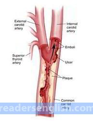 artery Urdu meaning