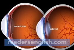 cataract Urdu meaning