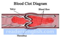 clot Urdu meaning