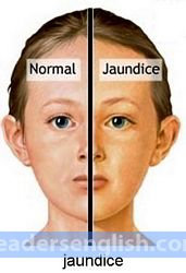 jaundice Urdu meaning