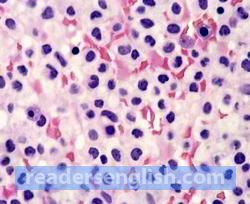 leukemia Urdu meaning